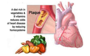 Hyperhomocysteinemia