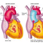 Ascending Aortic Aneurysm Icd 10