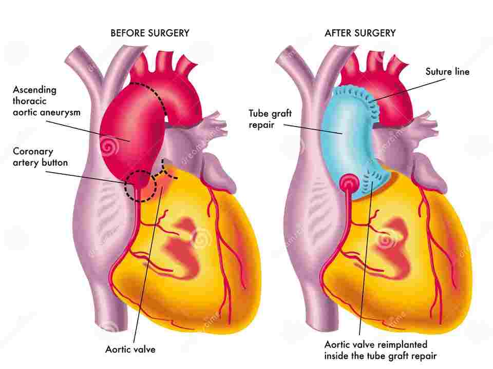 Ascending Aortic Aneurysm Icd 10