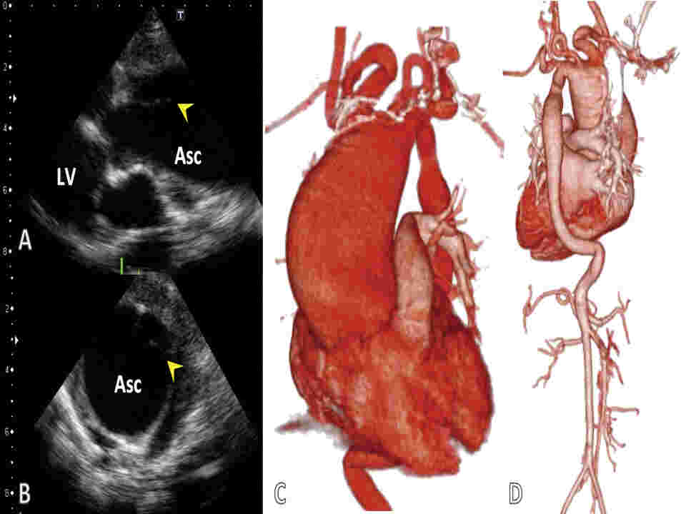 Ascending Aortic Aneurysm Icd 10