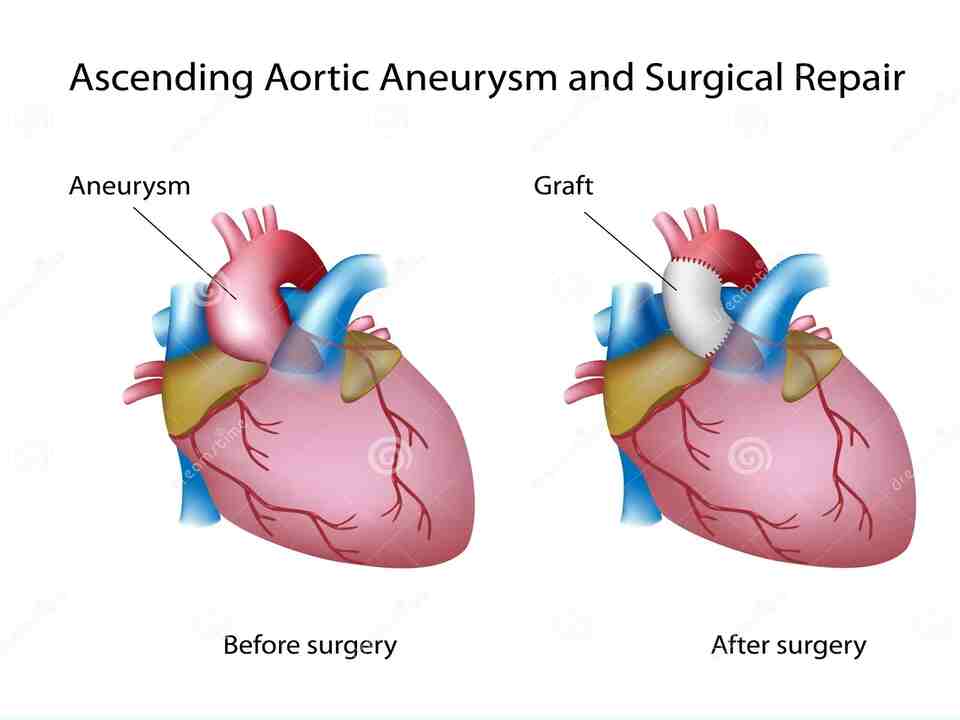 Ascending Aortic Aneurysm Icd 10