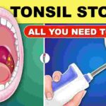 Tonsil Stones Removal Tool