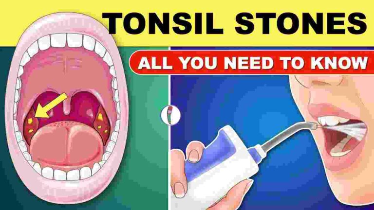 Tonsil Stones Removal Tool