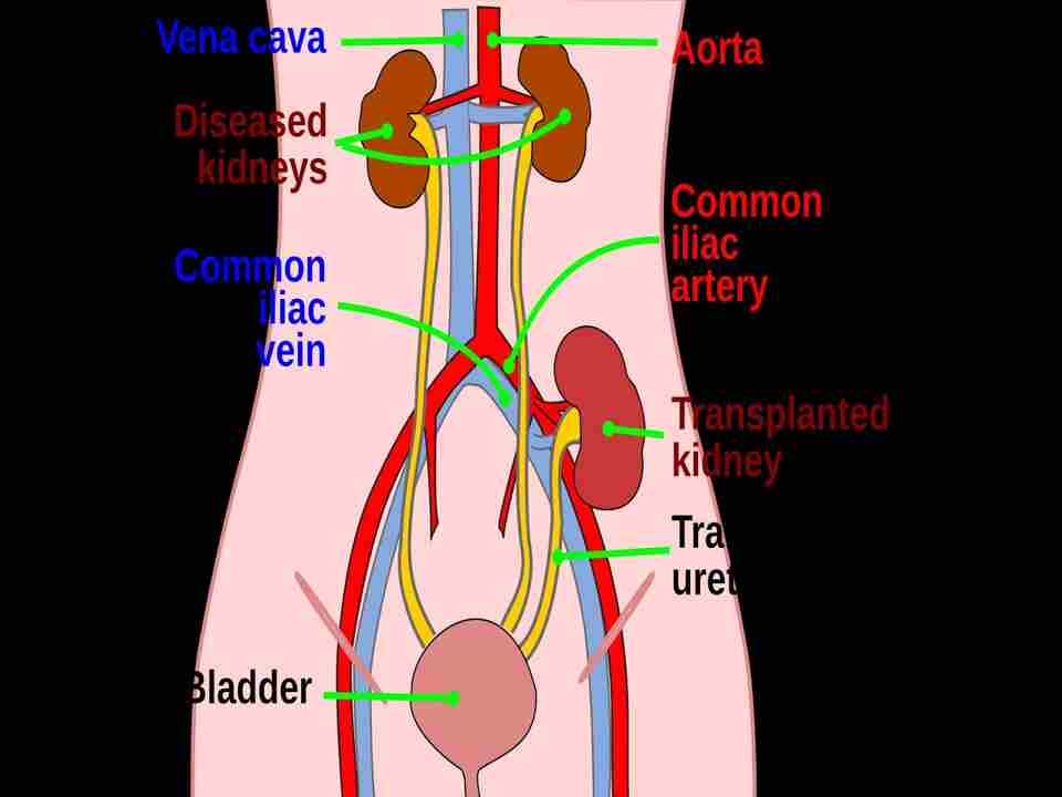 Icd 10 Code For Renal Transplant