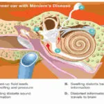 meniere's disease icd 10