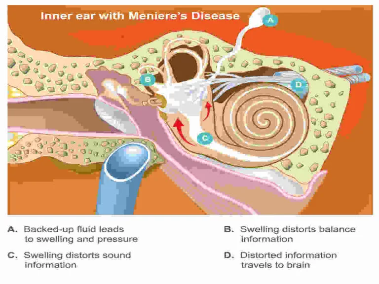 meniere's disease icd 10